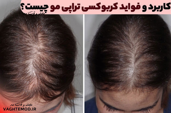 What are the uses and benefits of carboxy therapy?
