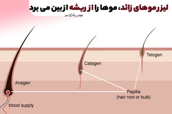 Laser hair removing hair from the root
