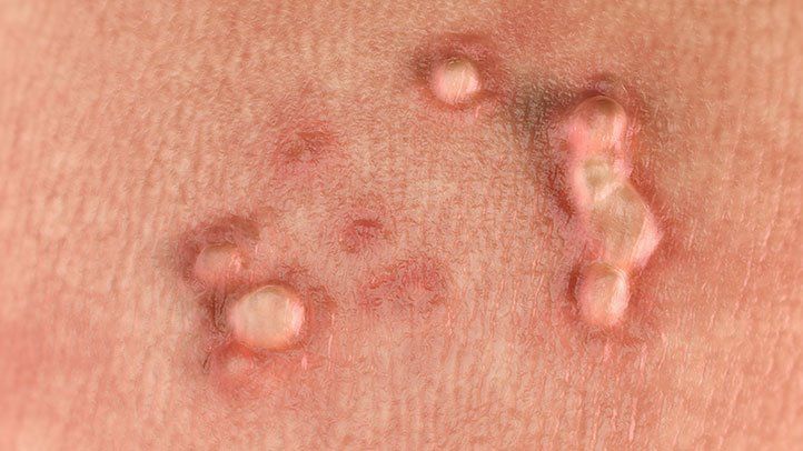 How do we find out the genital warts in women