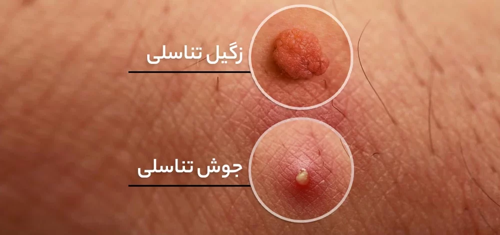 Pimples and genital warts