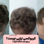 What is carboxy therapy?