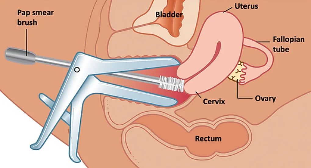 What is the poi in Pap smear?