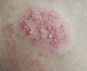 Appearance of genital herpes in women