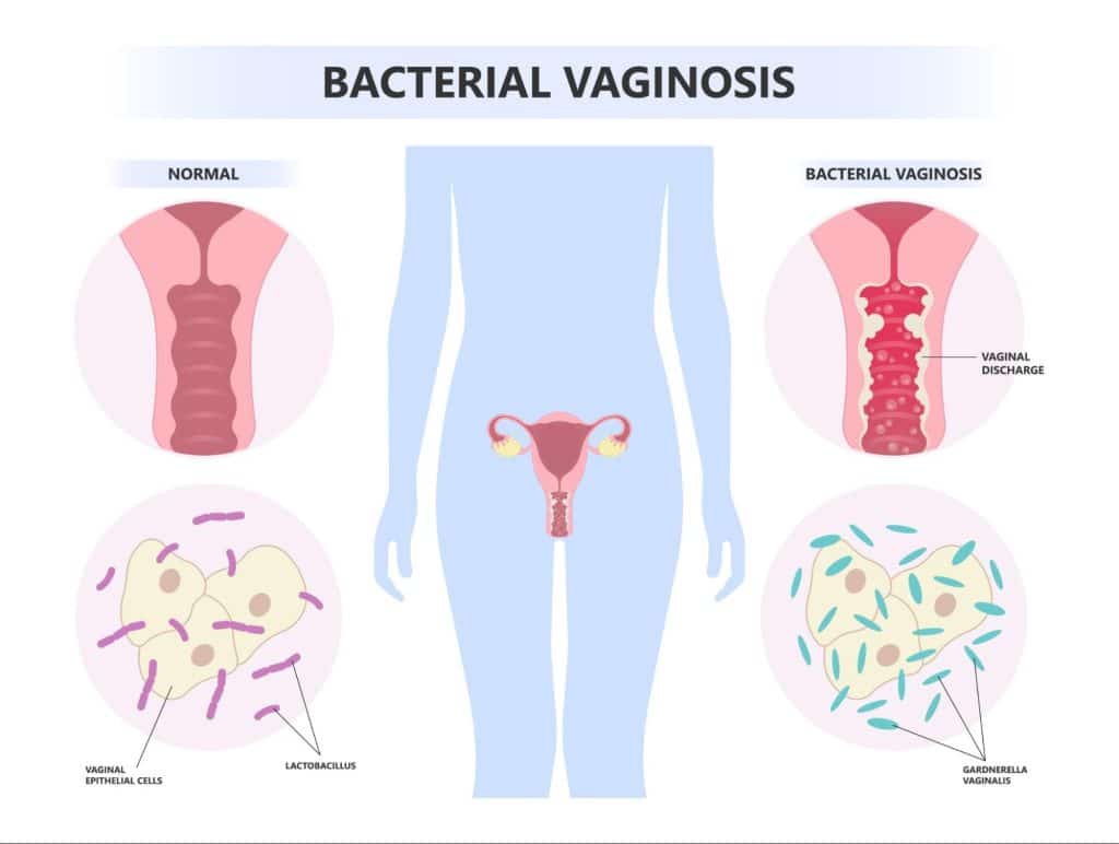 Symptoms of genital herpes in women