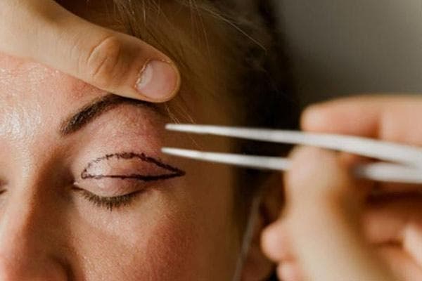 The shelf life of blepharoplasty