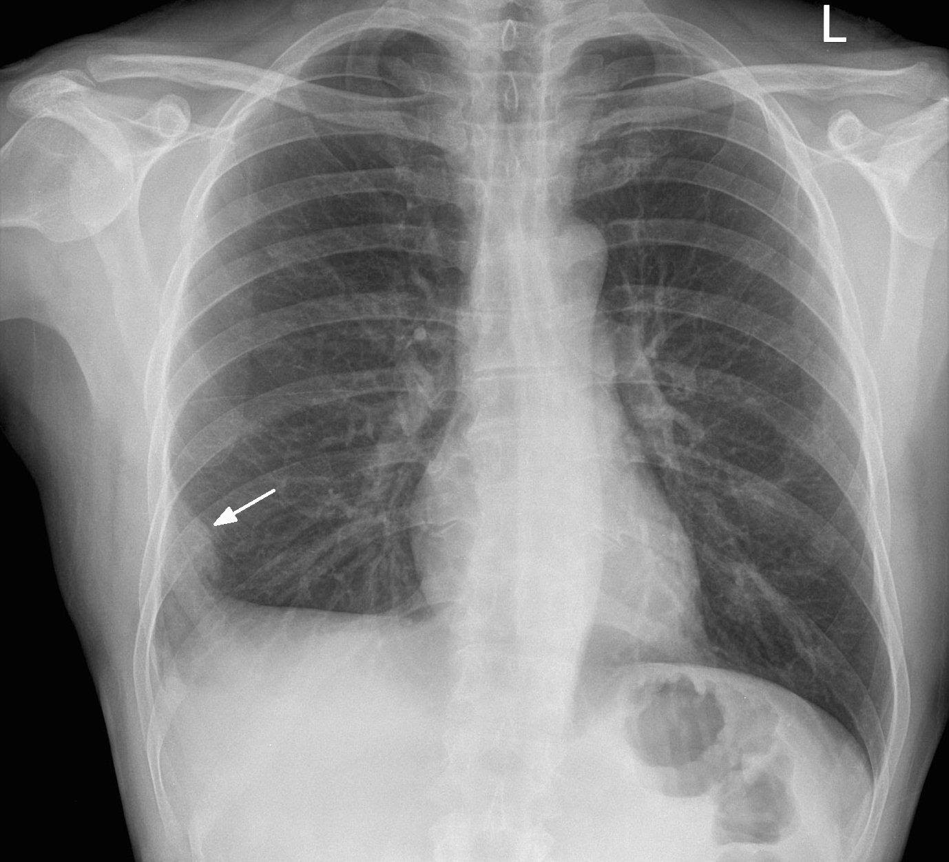Does the lung embolism have a definitive cure