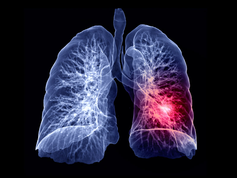 Complications after the treatme of lung embolism