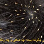 How is the lice egg? What kind and color is it?