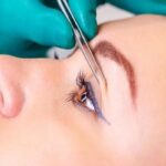 Shelf life of blepharoplasty