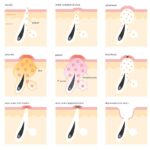 Scientific reasons for subcutaneous pimples with image and scientific