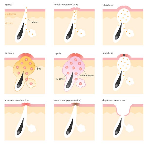 Scientific reasons for subcutaneous pimples with image and scientific