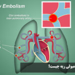 Lung embolism