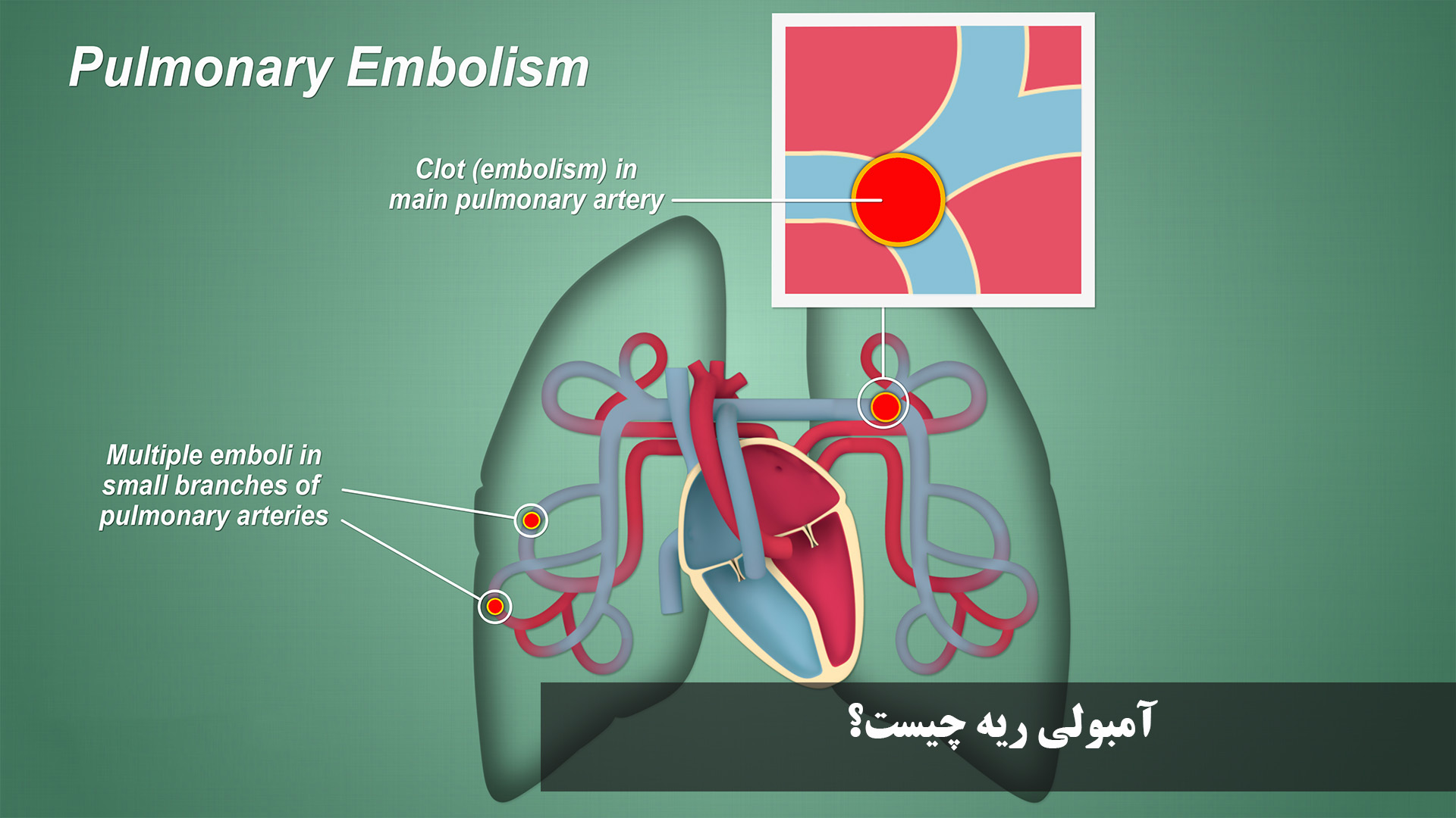 Lung embolism