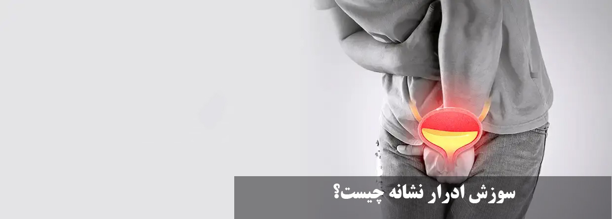 What is a sign of urine burning?