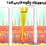 Laser hair removal
