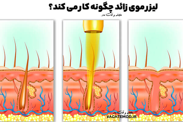 Laser hair removal