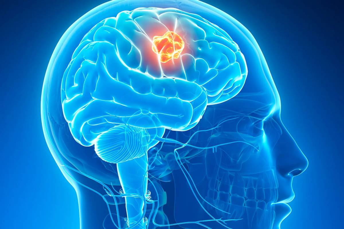 Treatme of brain cancer