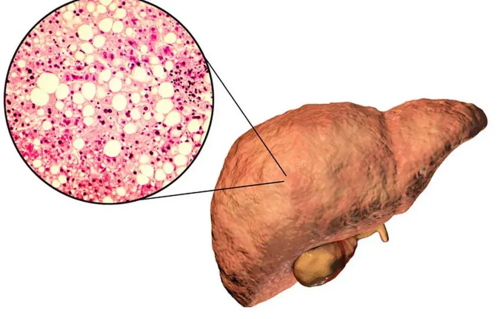 Cause of hepatitis
