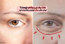 What is the cause of puffiness under the eyes? Know the methods of treating swelling under the eyes!