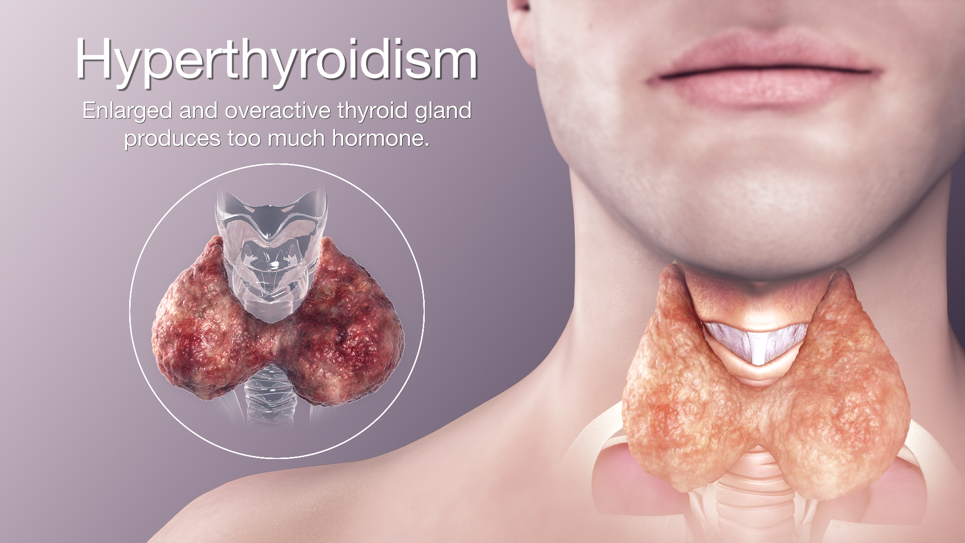 Common symptoms of hyperthyroidism in men