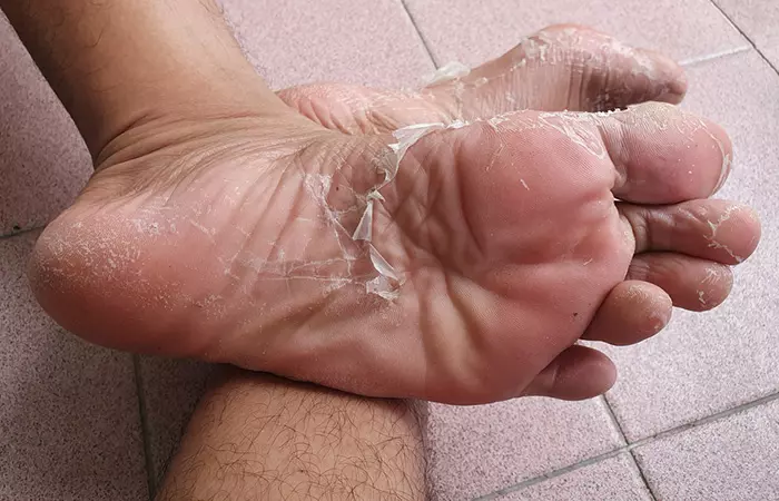 Home remedies for flaky soles