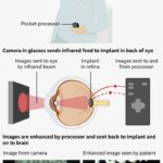 A new eye implant helps blind people read again - Diginoy