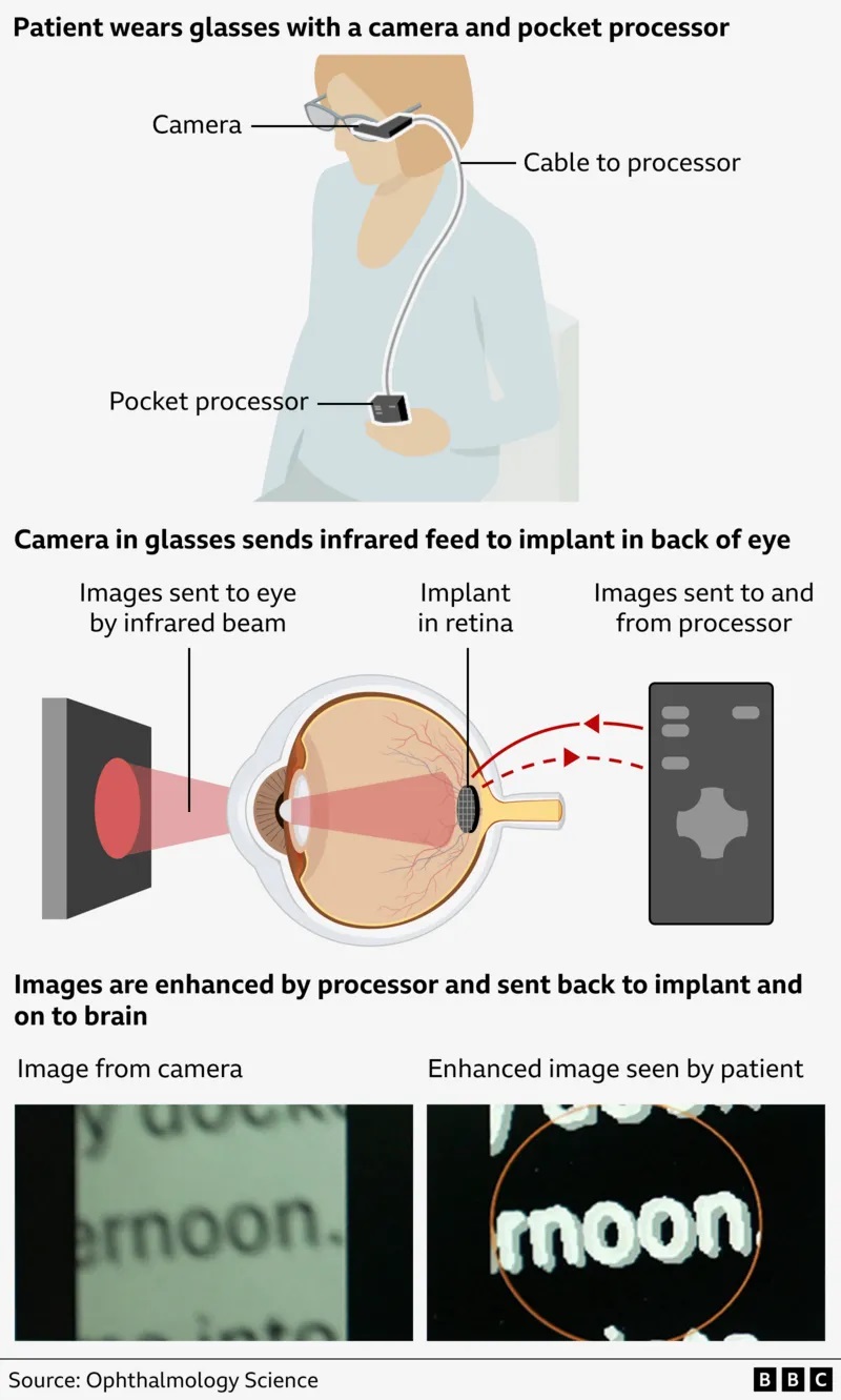 A new eye implant helps blind people read again - Diginoy