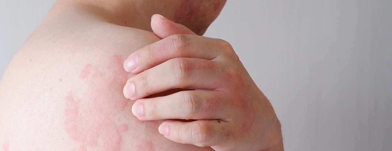 The strongest ai-allergic skin pill