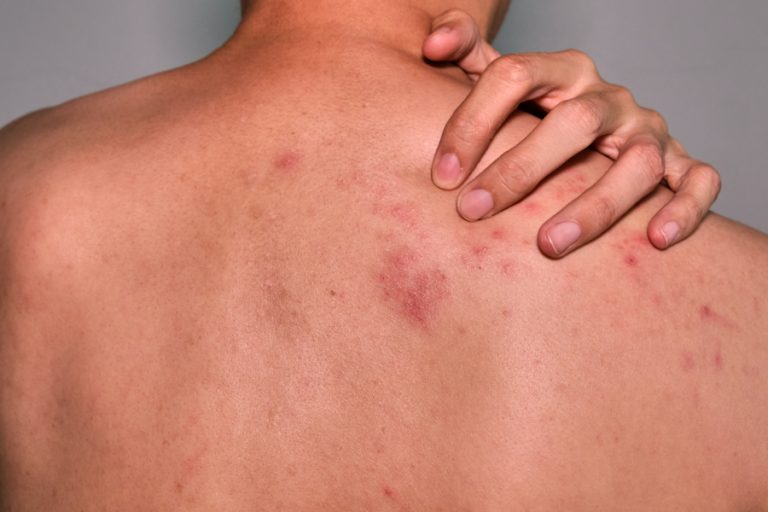 The best oime for pimples on the back