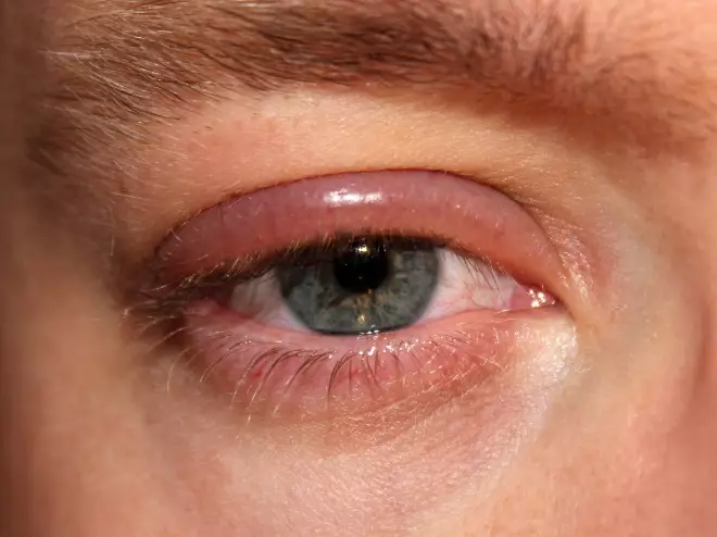The cause of cilia in the lower eyelid