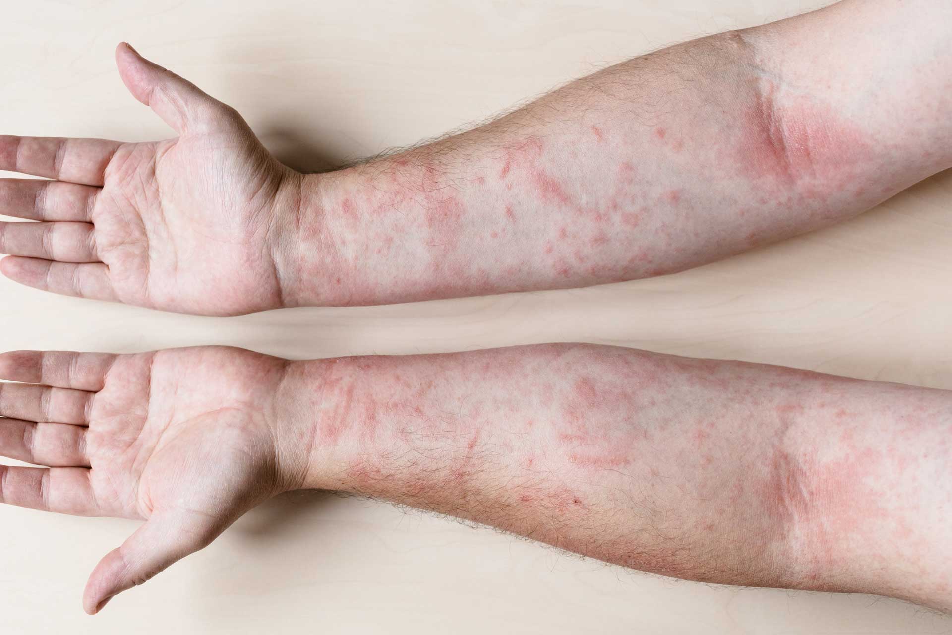 Is drug sensitivity dangerous?