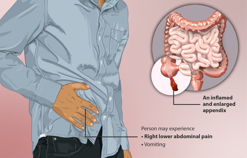 Does a ruptured appendix cause death?