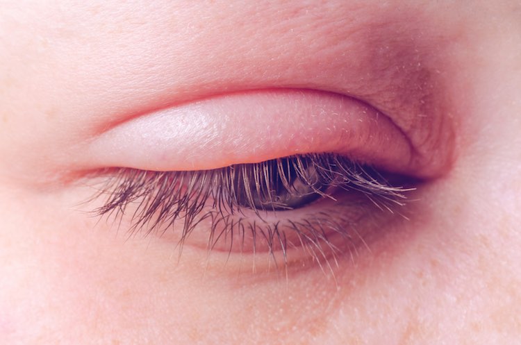 What is the cause of upper eyelid cilia?