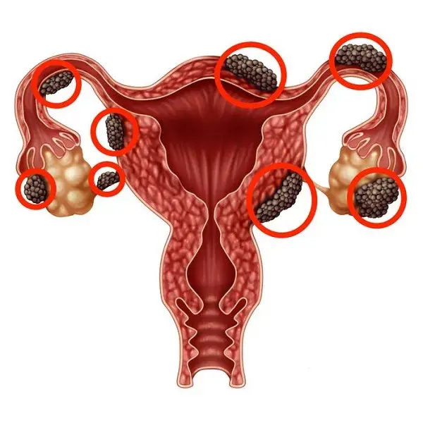 Treatme of endometriosis with Tebashir