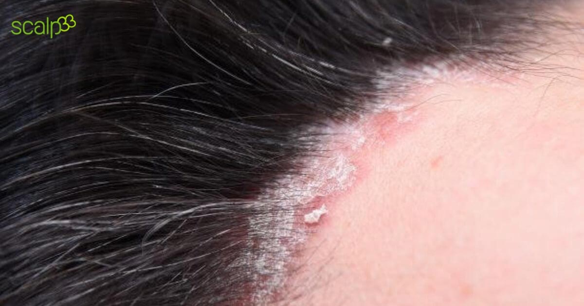 Psoriasis