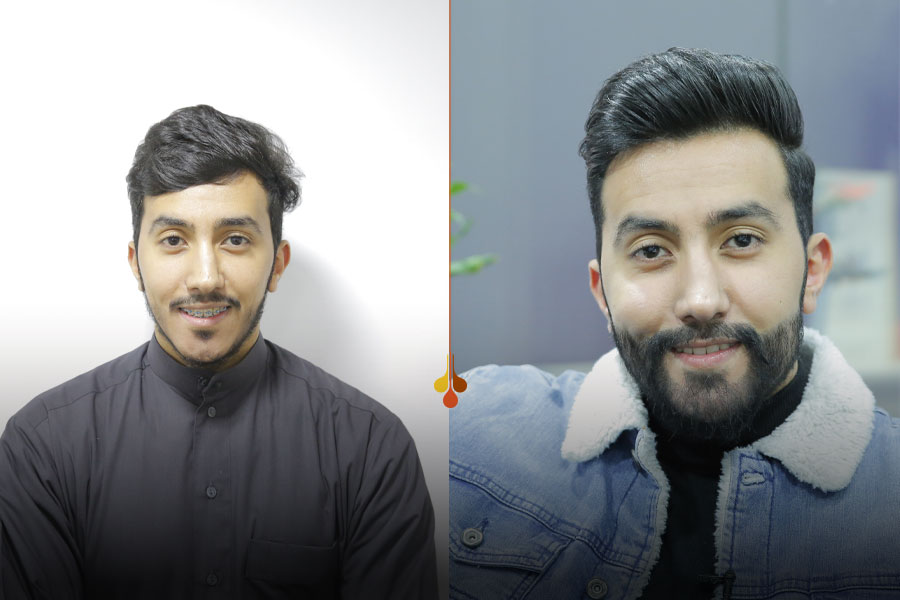 Beard transpla at Fakhrai clinic