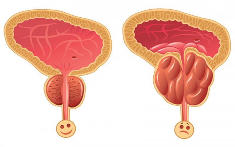 What to eat to treat prostate