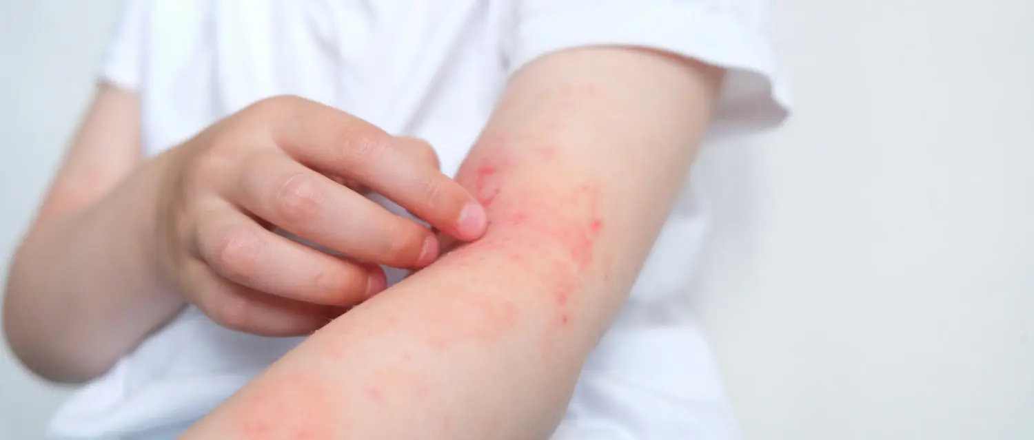 Home treatme of eggpla allergy What to do for eggpla allergy?