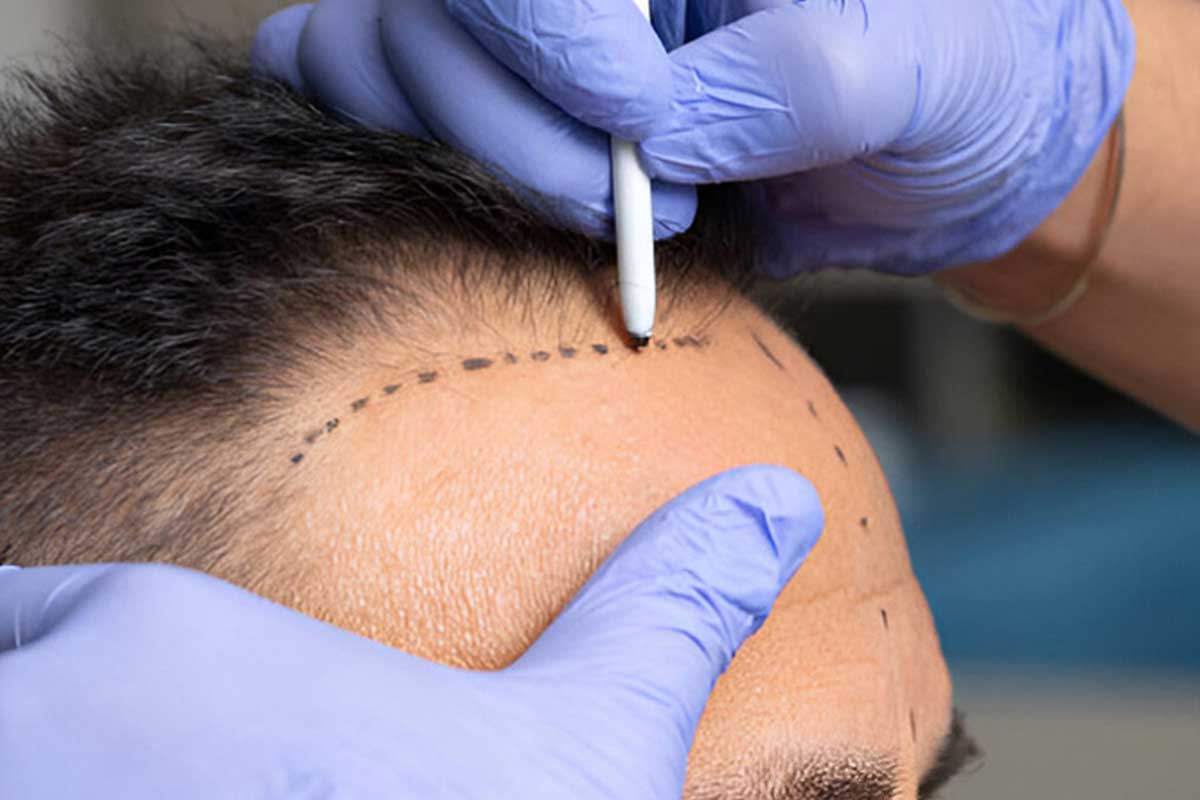 Hair transpla in Shiraz with anesthesia