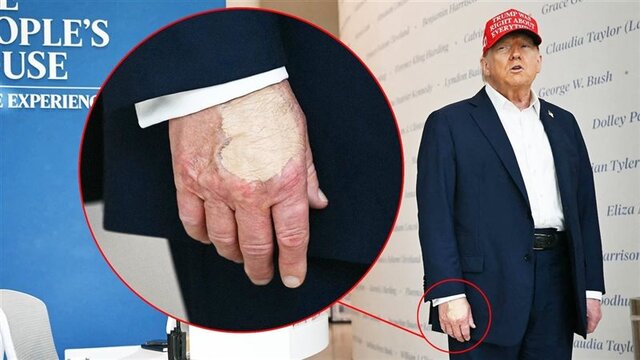 How did the White House justify the bandage on Trump's hand?
