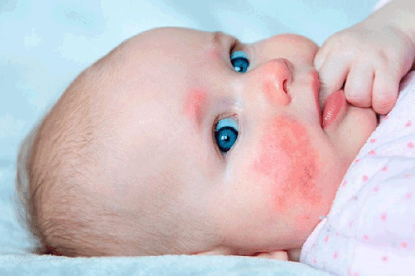 Symptoms of cow protein allergy in babies