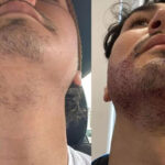 Why do some beard implants look artificial?