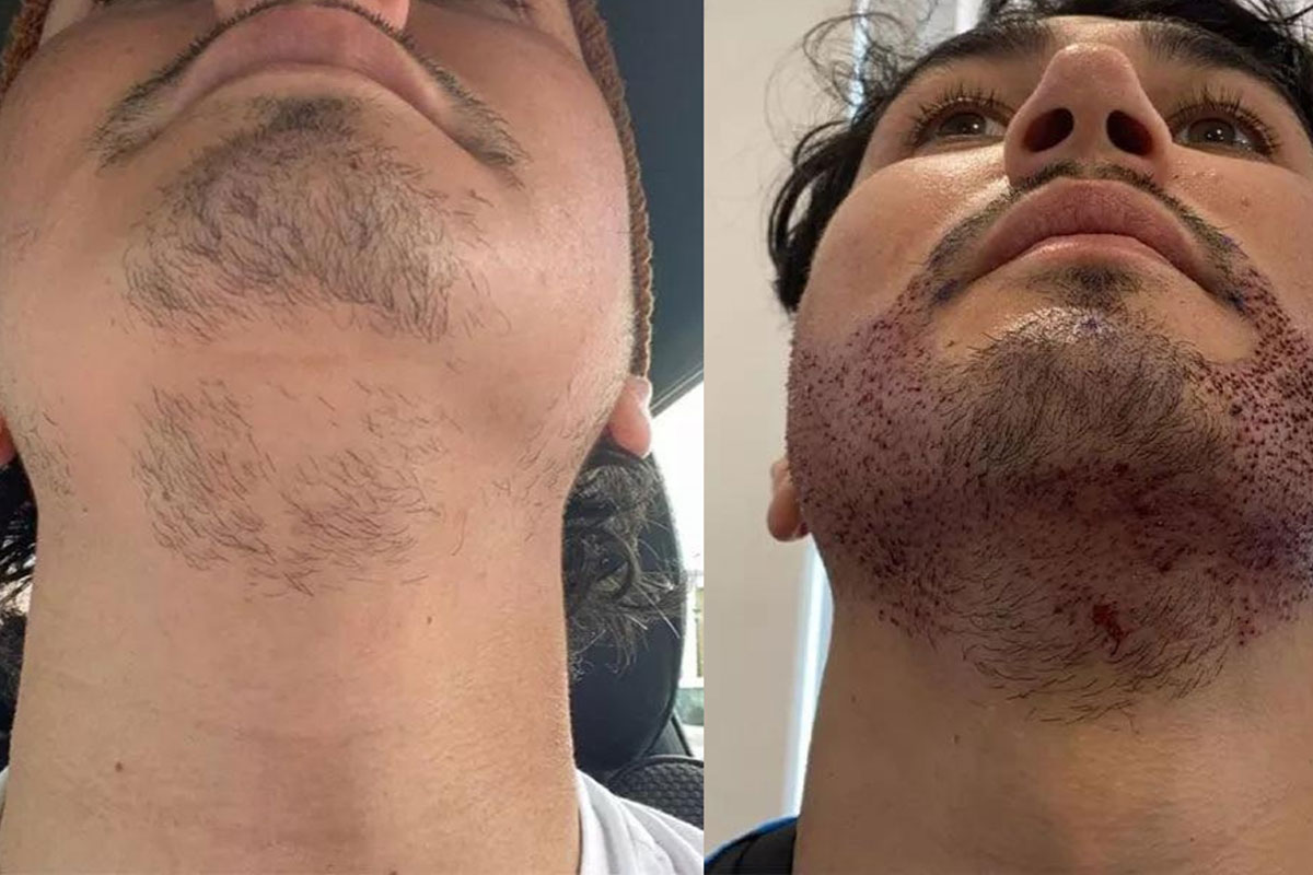 Why do some beard implas look artificial?