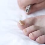nail fungus