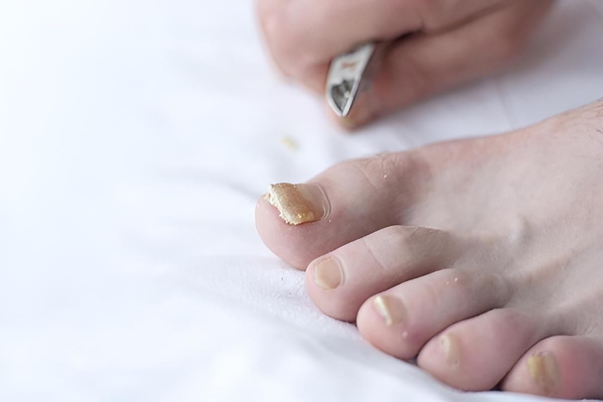 nail fungus