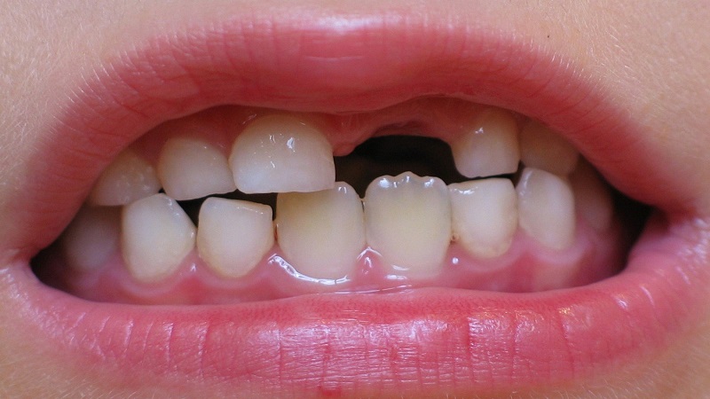 The cause of late eruption of permane teeth after the fall of milk teeth