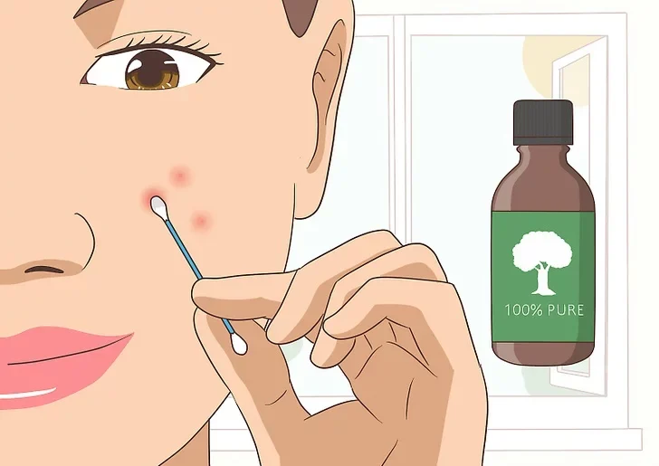 The role of tea tree oil in acne corol