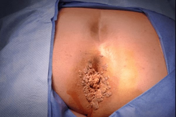 Anal warts
