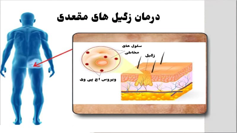 Treatme of anal warts