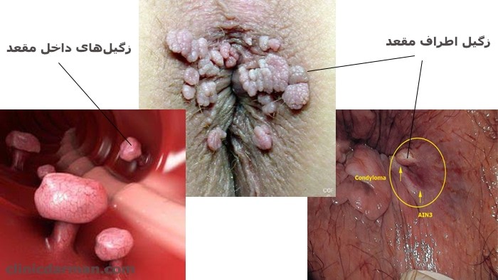 What is an anal wart?